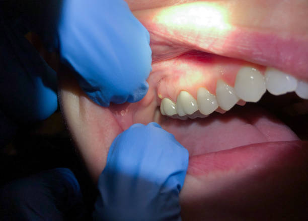 Best Dentist for Tooth Abscess  in Balfour, NC